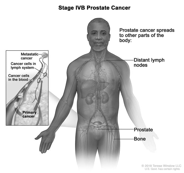 Prostate Cancer Metastatic XpertPatient