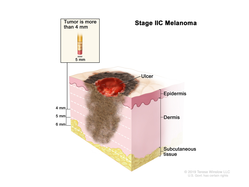 Stage 2 Melanoma Diagnosis - XpertPatient