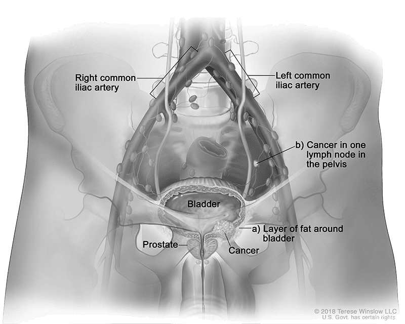 stage 3 urinary bladder cancer