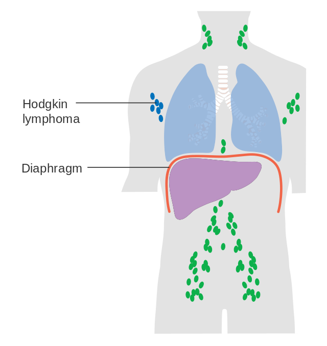 Stage 1 Follicular Non-Hodgkin Lymphoma Diagnosis