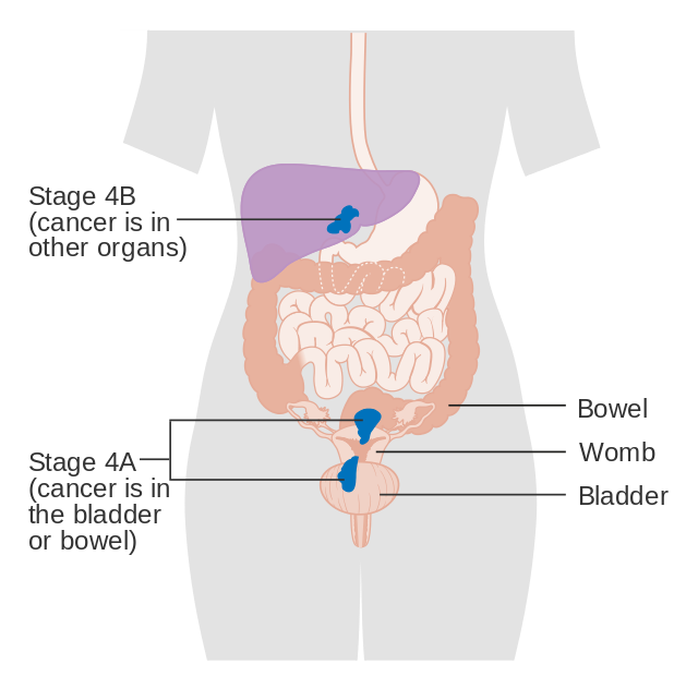 stage-4-endometrial-cancer-diagnosis-xpertpatient