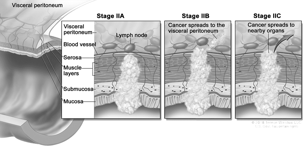 stage 2 colon cancer meaning