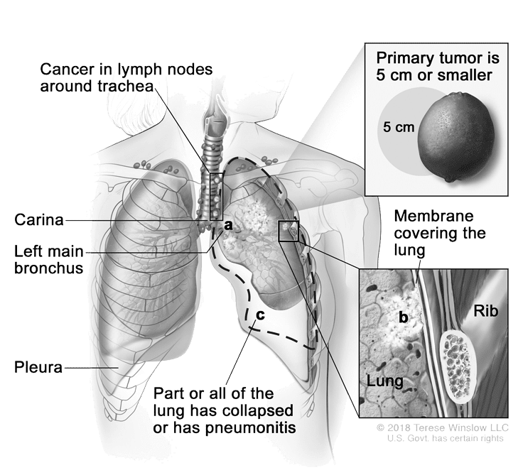 Lung Cancer Non Small Cell Stage 3 - XpertPatient