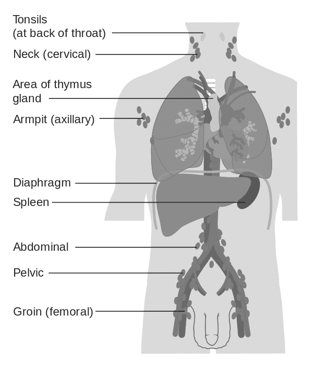 Non Hodgkin Lymphoma Cancer Diffuse Large B-cell - Xpertpatient