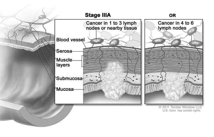 rectal-cancer-stage-3-xpertpatient