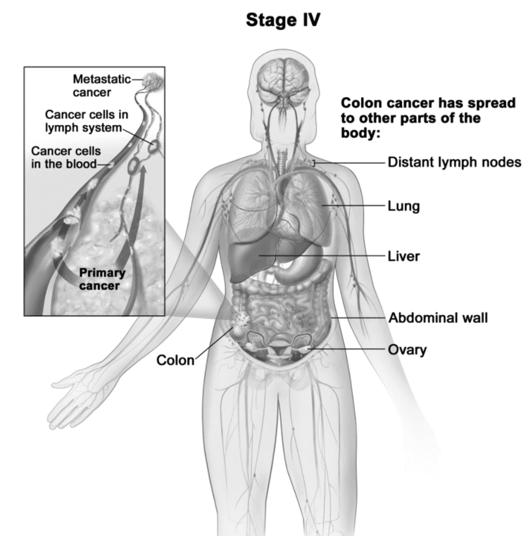 rectal-cancer-stage-4-xpertpatient